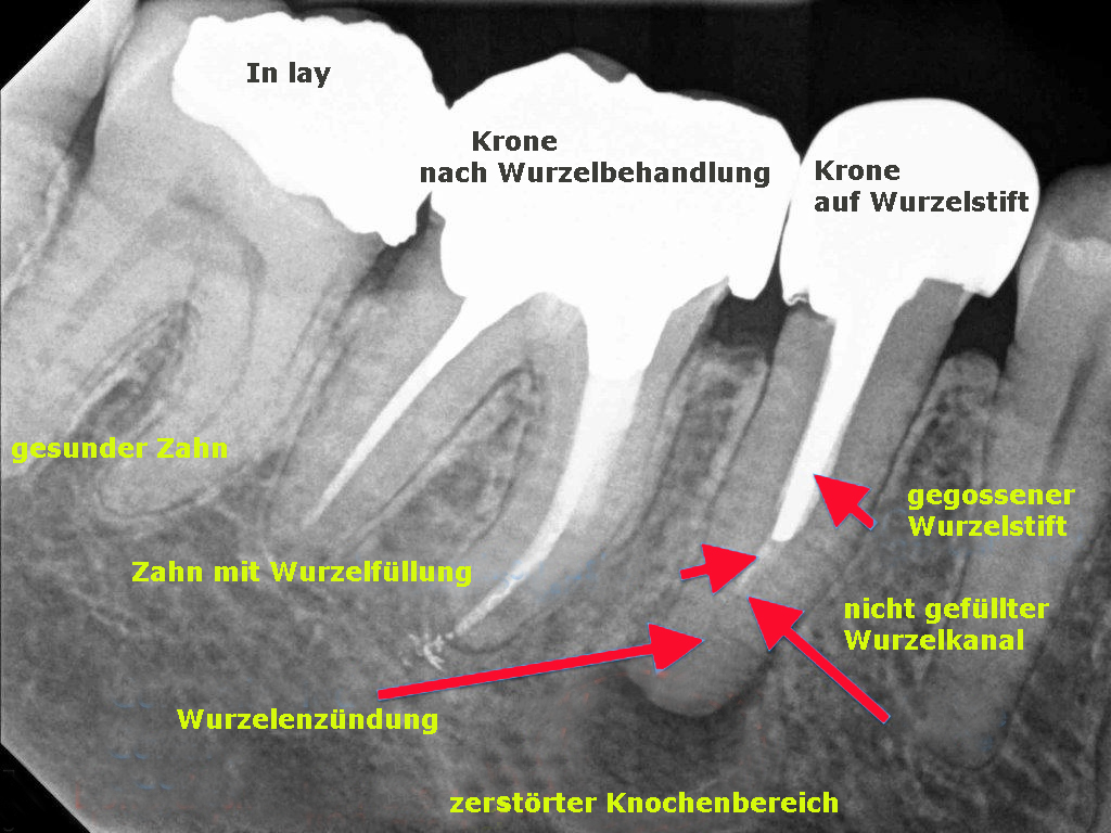 Wurzelbehandlung Endo - Zahnersatz Preiswert - Implantate günstig